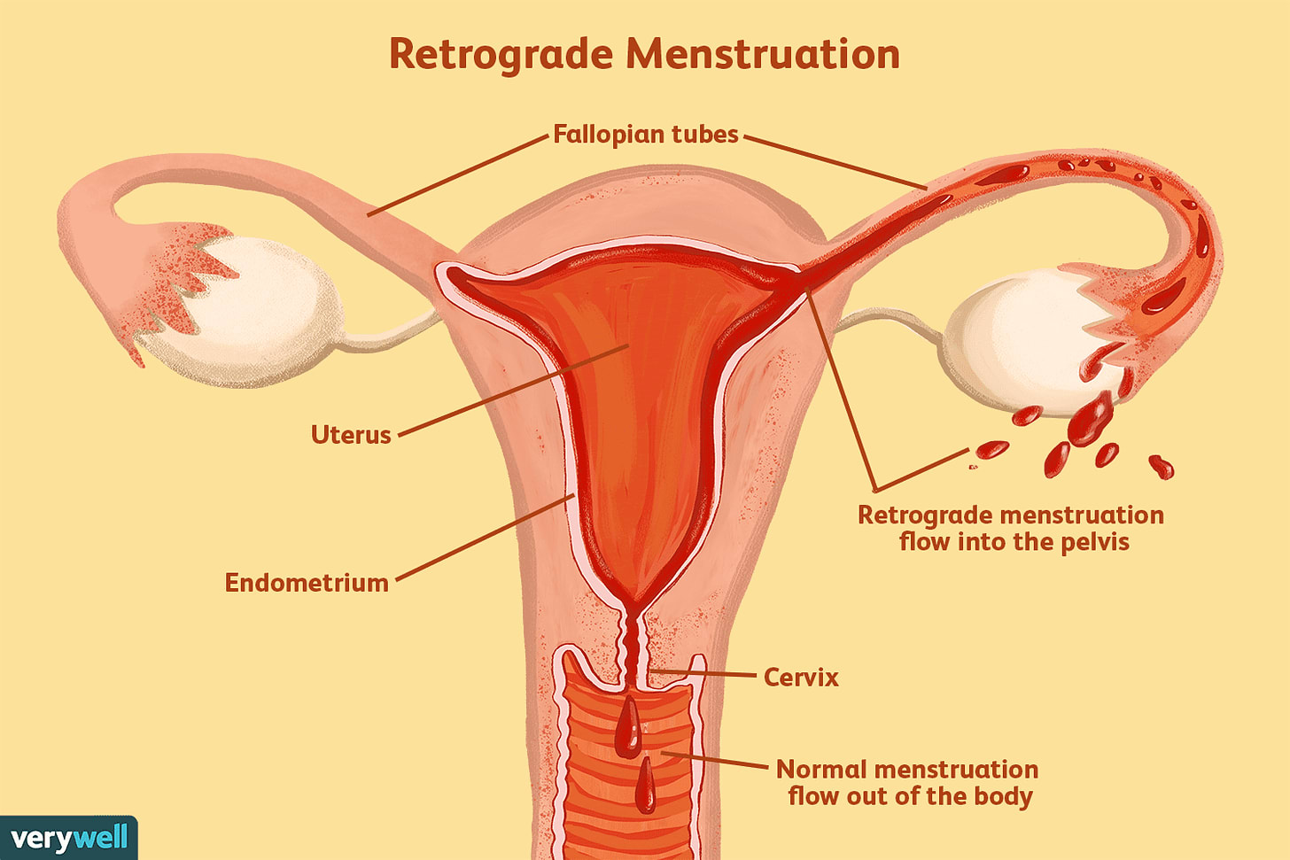 Retrograde Menstruation: Symptoms, Causes, Diagnosis