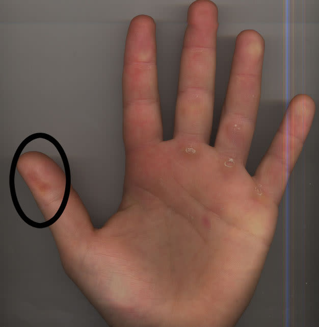 Does anyone else get this from hook grip? : r/weightroom